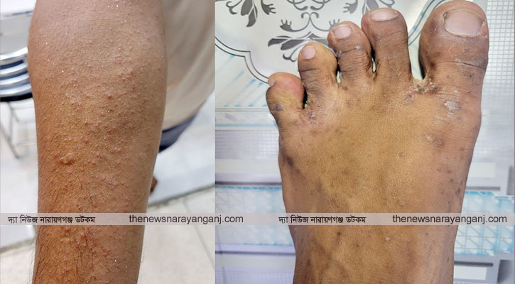 নারায়ণগঞ্জে ভয়ঙ্কর এলার্জি