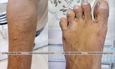 নারায়ণগঞ্জে ভয়ঙ্কর এলার্জি